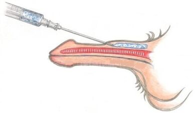 agrandamiento del pene inyectable