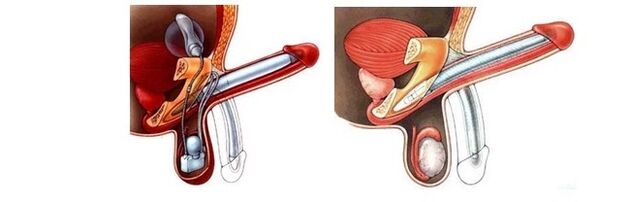 prótesis de alargamiento del pene