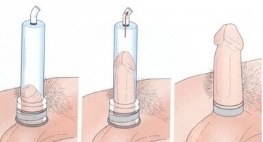 Agrandamiento del pene usando una bomba